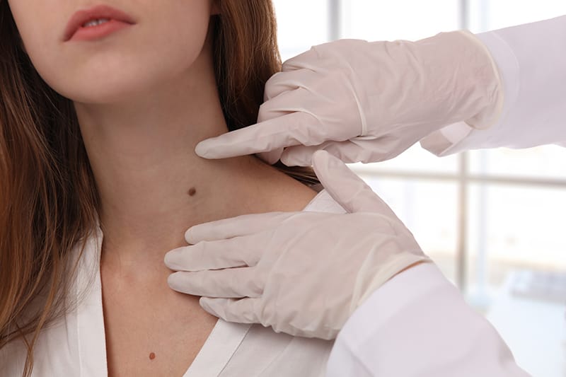 doctor inspecting woman's mole