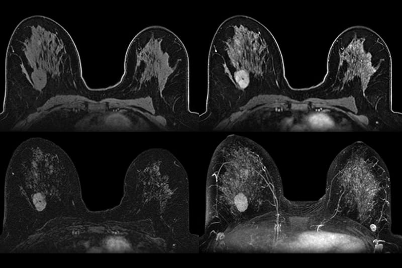 four abbreviated breast mri scan images