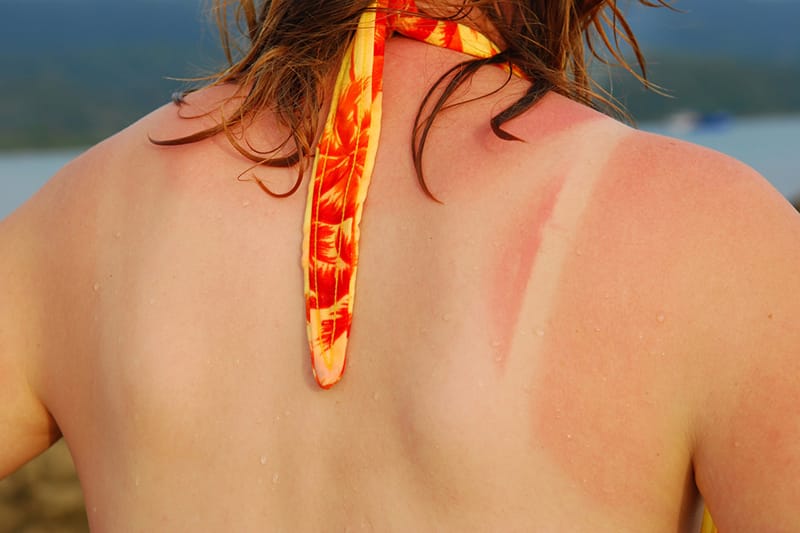 Dermatology Tips For Soothing A Sunburn The Iowa Clinic